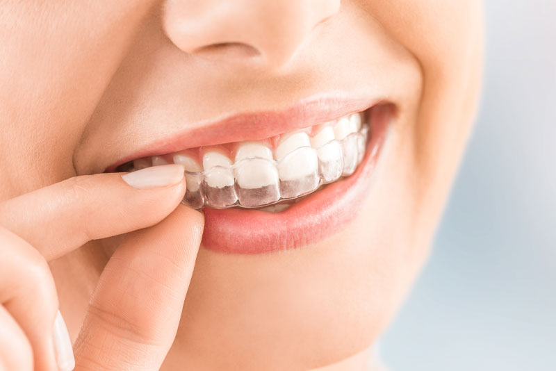 clear aligners model