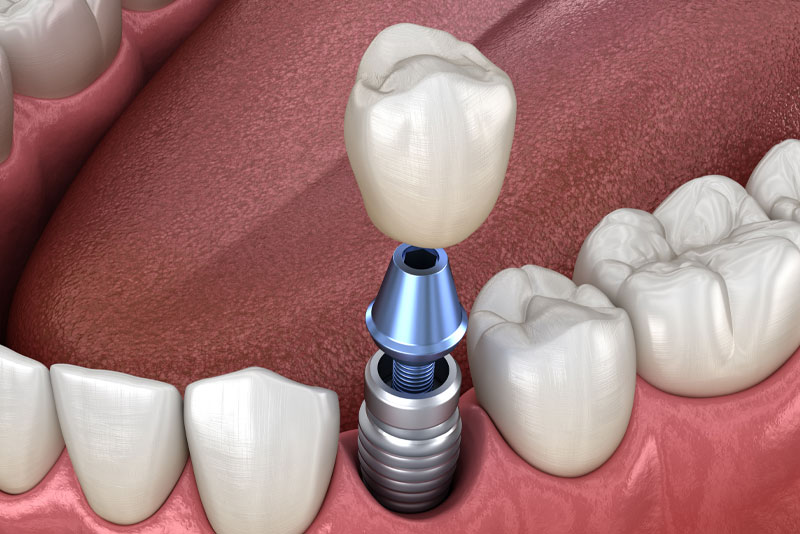 Are There Specific Parts That Make Up A Dental Implant?